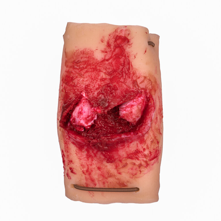 Simulator de fractură de antebraț TactiFlesh®